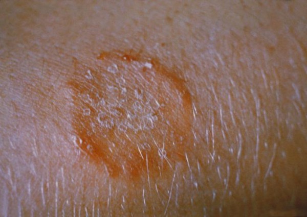 tzara-ringworm-psoriasis-impetigo-sores